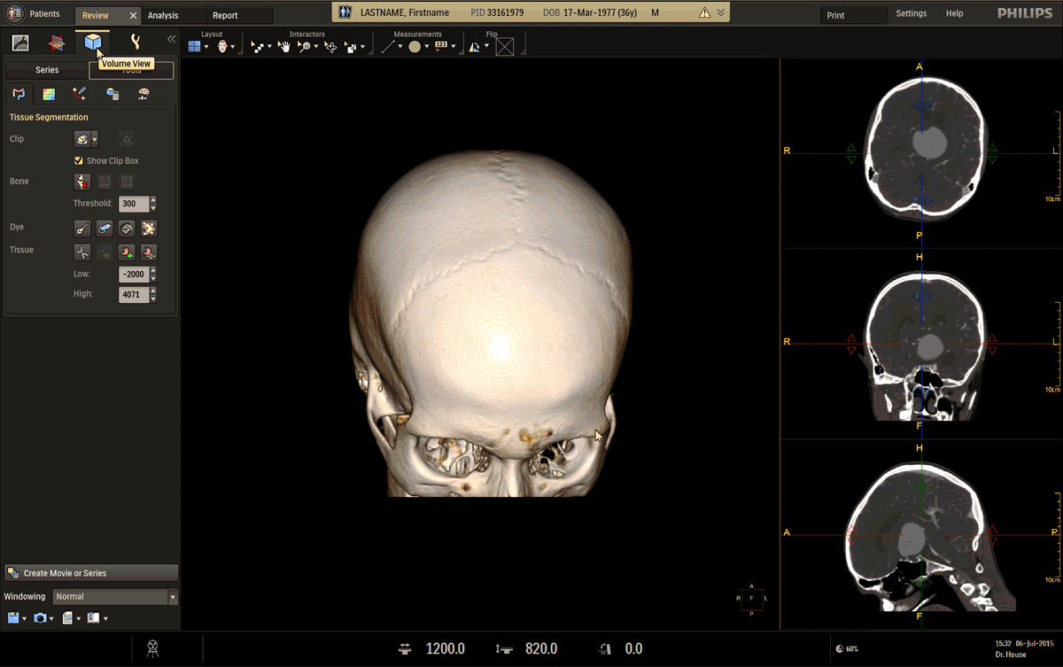 Beeldscherm ontwerp van een medische toepassing met daarop een drie dimensionale scan van een deel van de schedel en gereedschappen om het te bewerken.